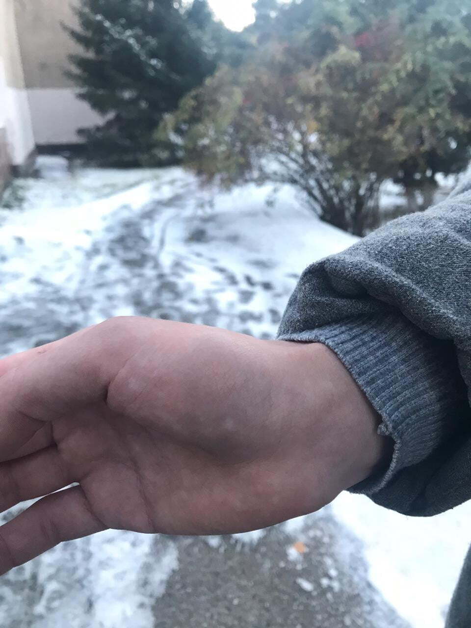 П’яний директор бальнеолікарні ЗАТ “Укрпрофоздоровниця” напав на журналістку “СтопКору” і пошкодив їй руку