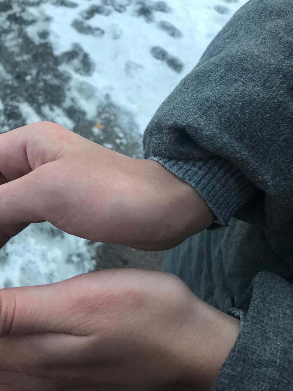 П’яний директор бальнеолікарні ЗАТ “Укрпрофоздоровниця” напав на журналістку “СтопКору” і пошкодив їй руку