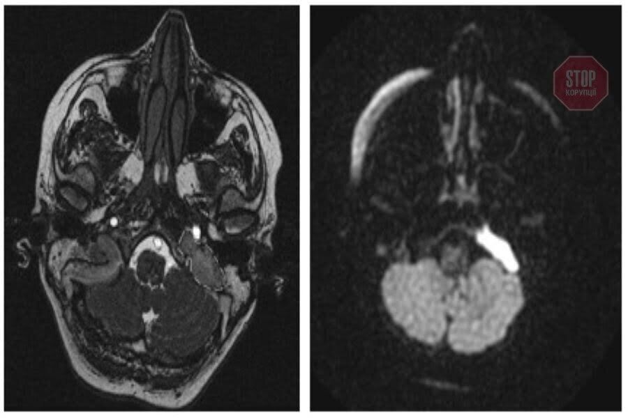 Унікальна операція на головному мозку: в Дніпрі боролися з новоутворенням скроневої кістки (фото)