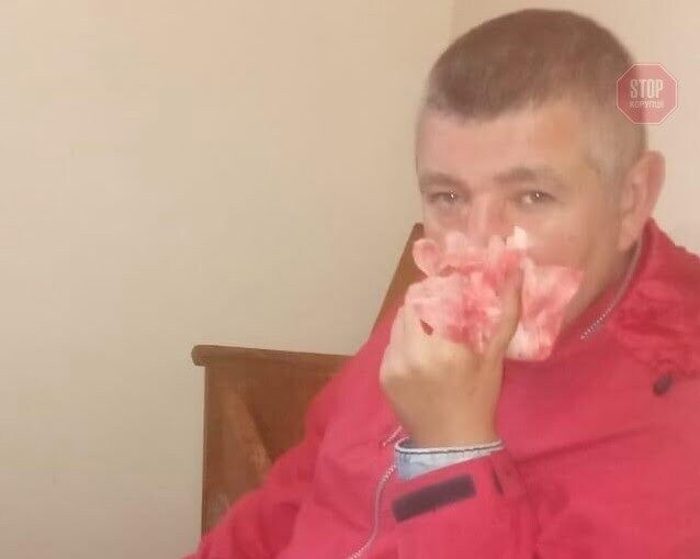  В Олевську скоєно напад на активіста ''Стоп корупції''. Фото: СтопКор.