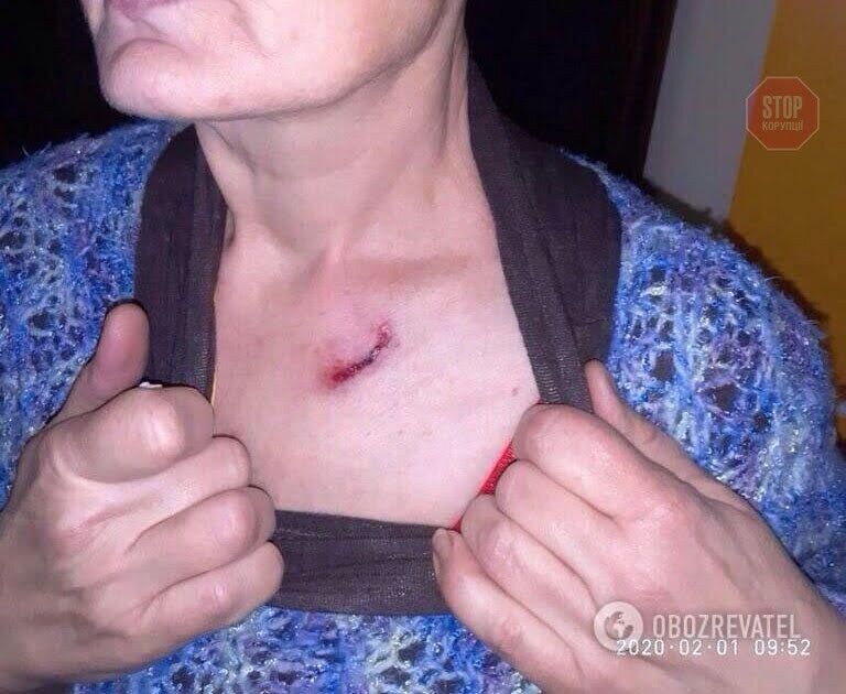 Під Києвом бійцівські собаки телеведучої каналу ''Україна'' жорстоко покусали двох жінок (фото)