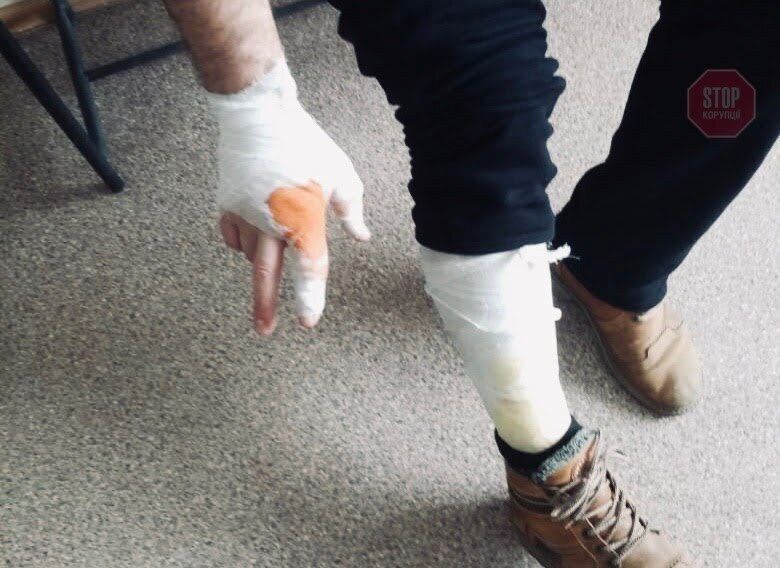  Активіст отримав опіки ноги та руки Фото: СтопКор