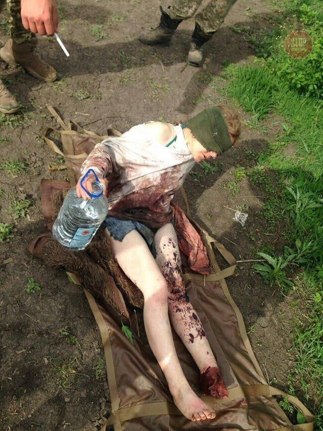 На лінії розмежування жінці відірвало гранатою стопу (фото)