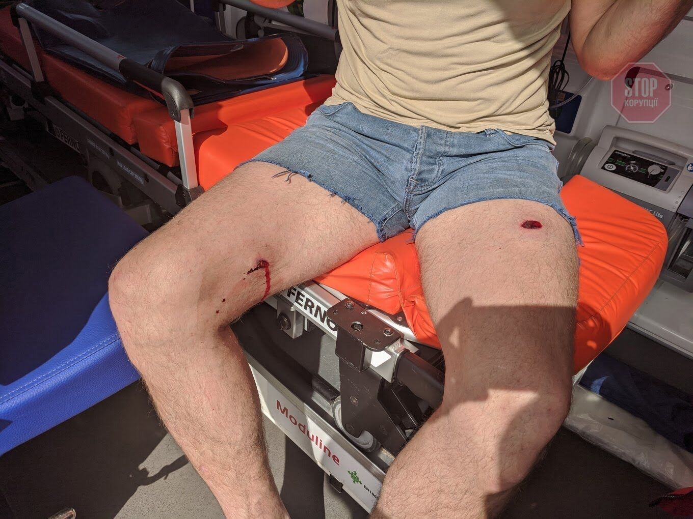 На Київщини депутату прострелили ногу (фото, відео)