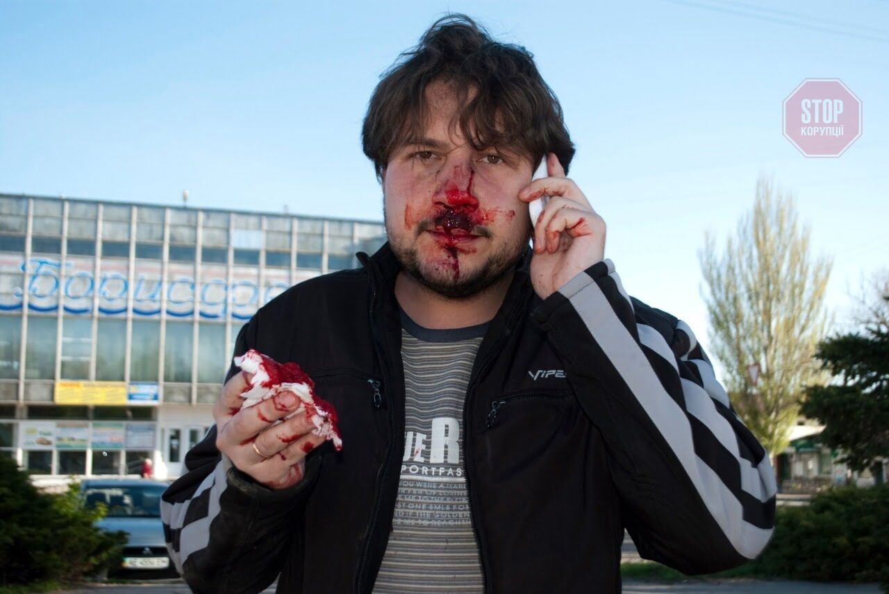  Журналісту зламали ніс Фото: СтопКор