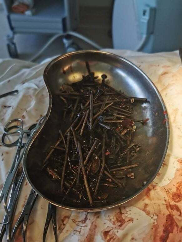 Чоловік місяць ковтав метал, як кинув пити – з нього витягли кілограм гайок і гвинтів