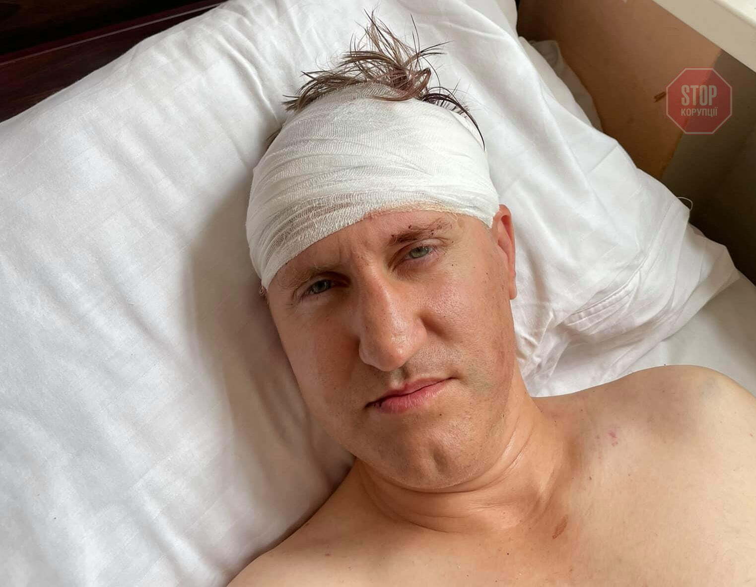  Побитий депутат Коростенської міськраді перебуває у лікарні. Фото: соціальні мережі