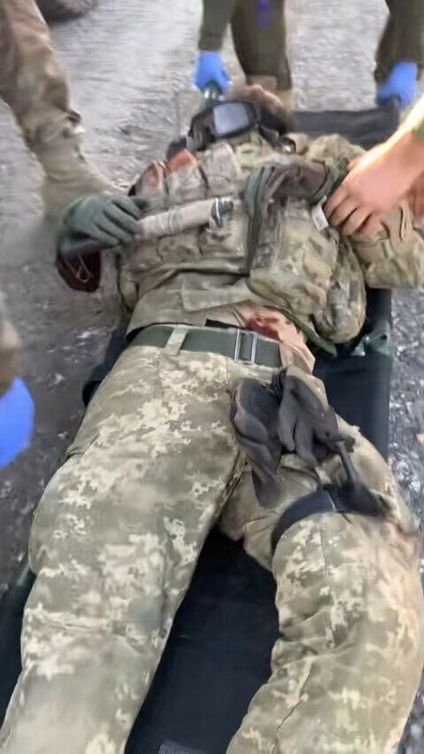 Ранение бойца ВСУ – перетянутая нога