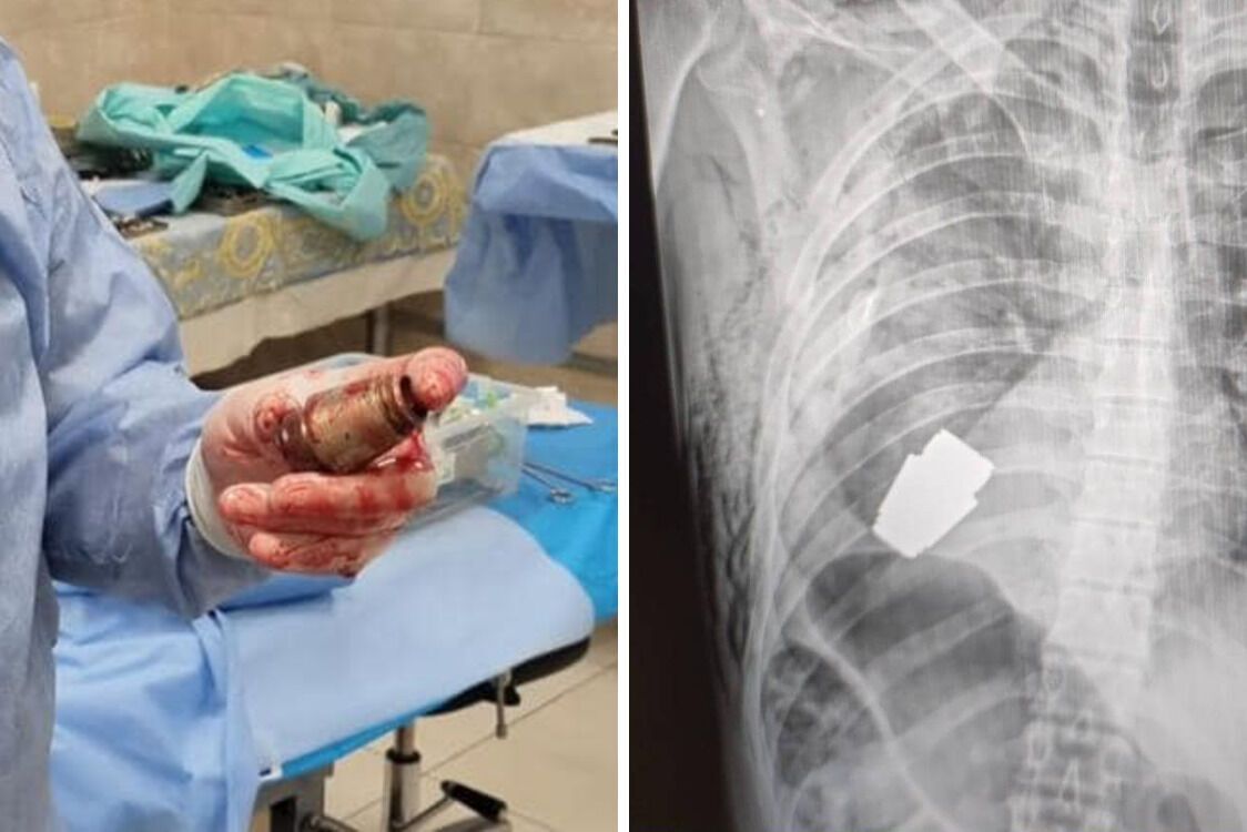 Хирург удалил из тела бойца ВСУ гранату ВОГ, которая не сдетонировала при попадании: детали