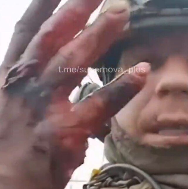 Поранена рука бійця ЗСУ, який брав участь  таємному рейді на лівобережжя Херсонщини