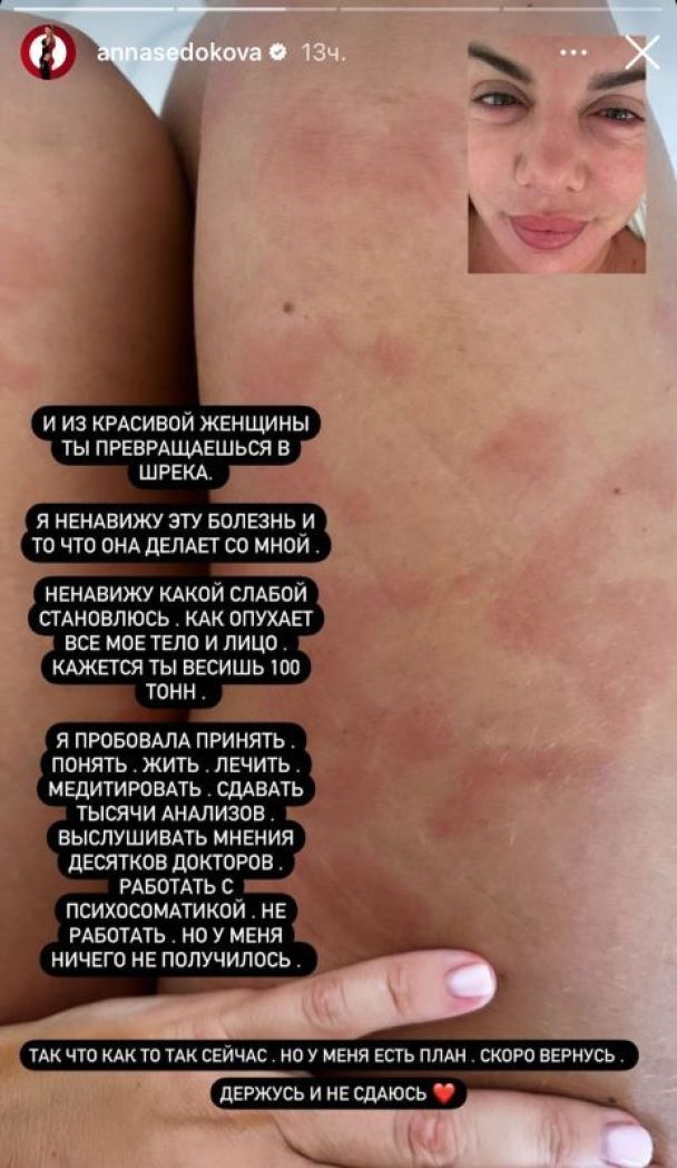 Хвороба спотворила обличчя Анни Сєдокової: що сталося зі співачкою