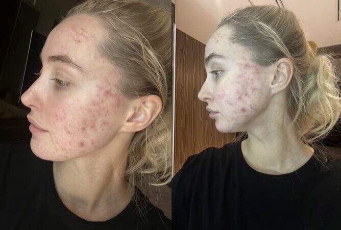 Барановська - відверте фото з акне