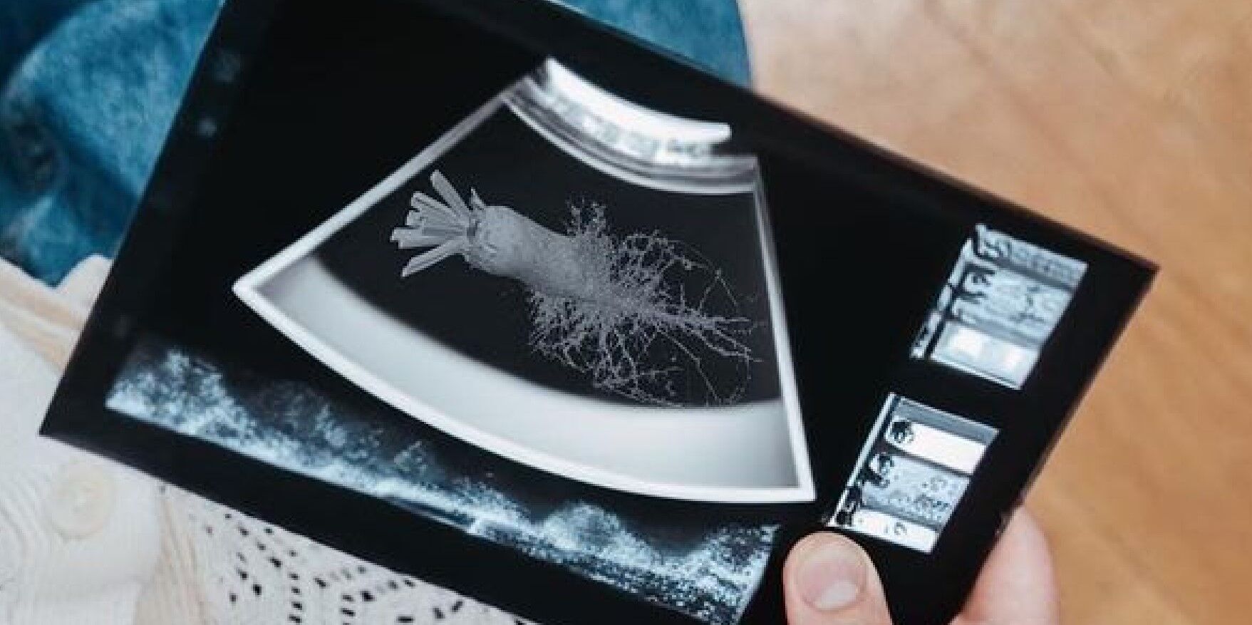 УЗИ ''плода'', который рассматривает Клопотенко