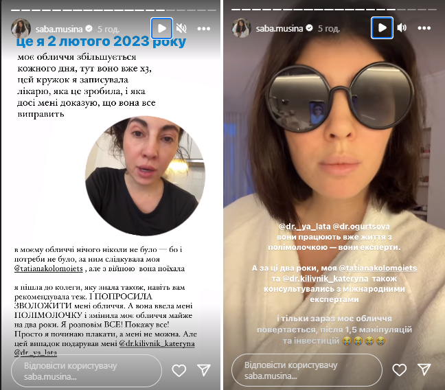 Моє обличчя збільшувалось: блогерка Сабіна Мусіна стала жертвою невдалої процедури у косметолога 
