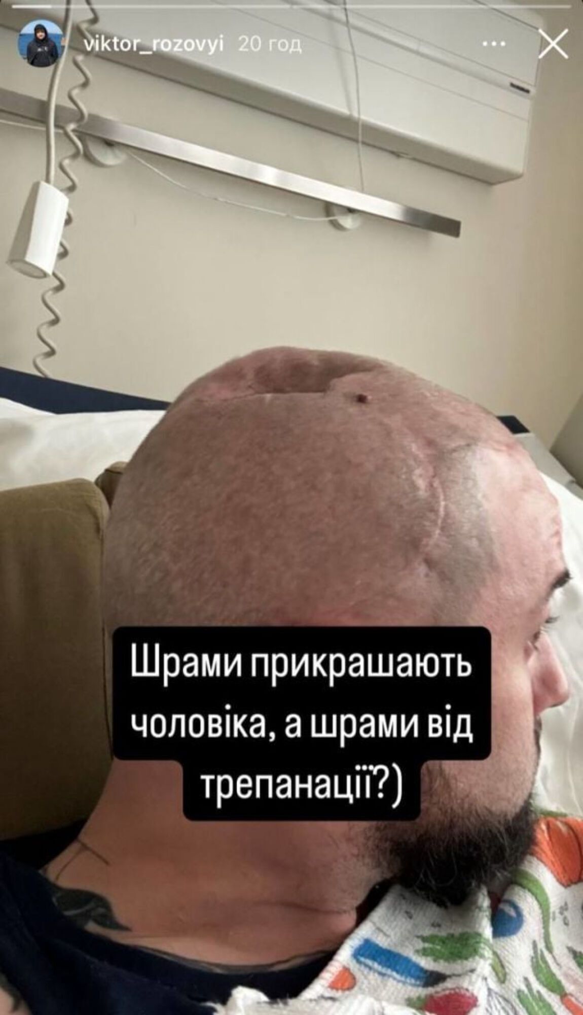 Звезда ''Лиги Смеха'' Розовый показал последствия трепанации черепа после осколочного попадания на фронте