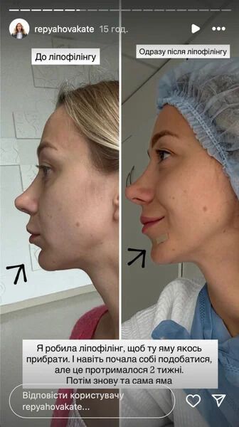 Репьяхова снова легла под нож: последствия операции