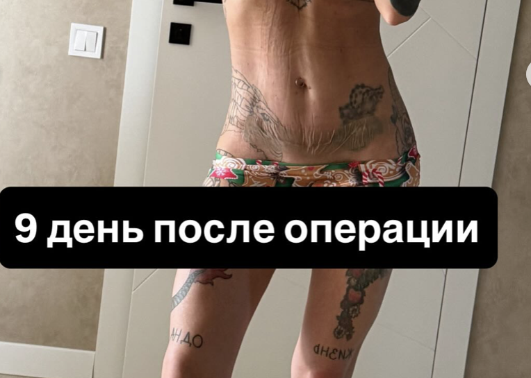 Операция по цене машины: скандальная блоггерша Алхим назвала цену ''тюнинга'' своего тела