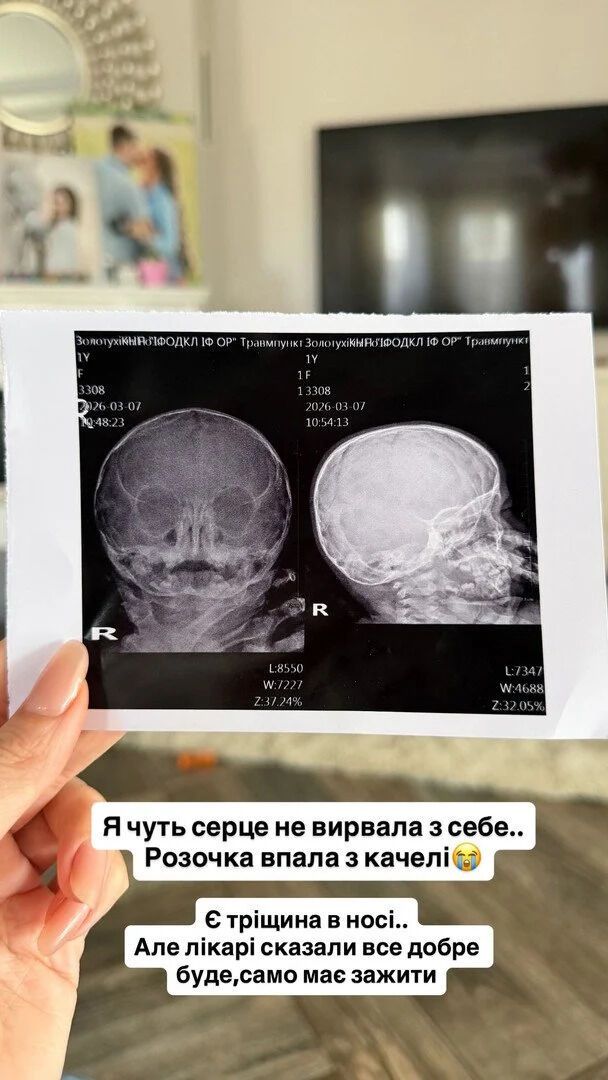 Донечка блогерки Юлії Верби дістала тріщину в носі після падіння
