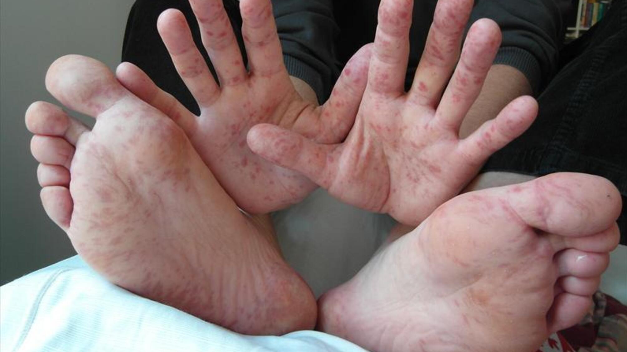 У Кривому Розі 14 осіб інфікувалися вірусом Коксакі