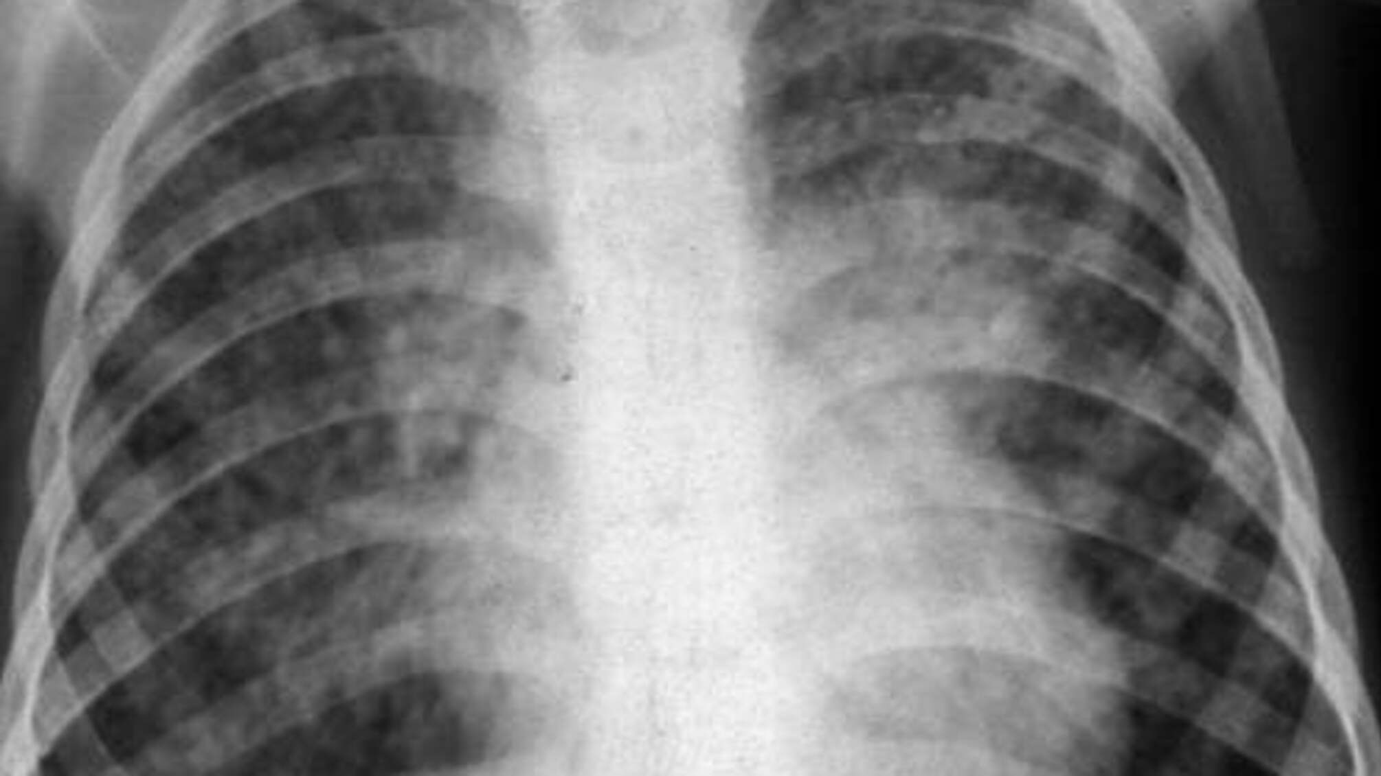 'ЛНР' на межі епідемії туберкульозу: з початку року рівень смертності від захворювання виріс на 25 відсотків