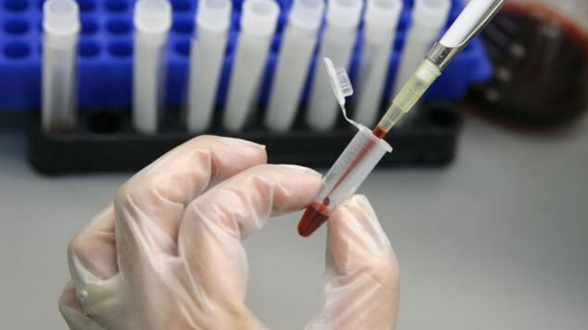 Поліція відкрила кримінальне провадження через масове зараження гепатитом А жителів Миколаєва