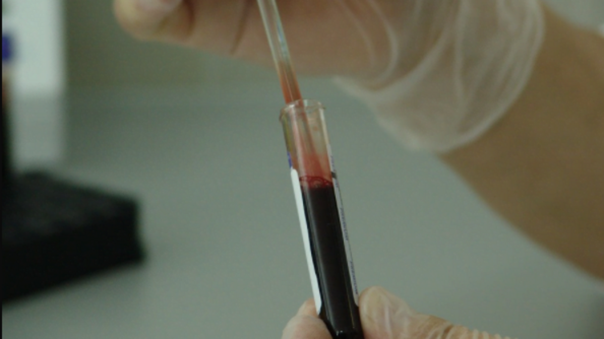 Ситуація з хворими на ВІЛ на Донбасі вийшла на новий рівень