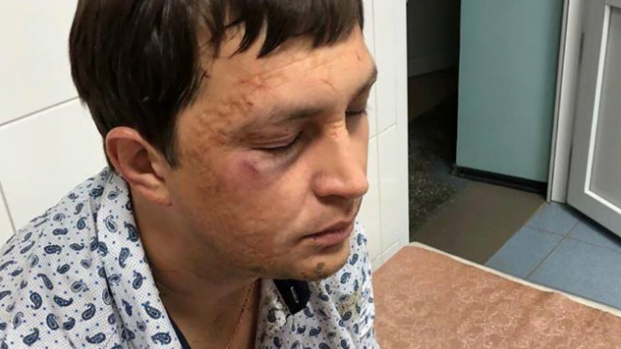 У реанімації з підозрою на гематому головного мозку: нові подробиці нападу на еколога Діброва