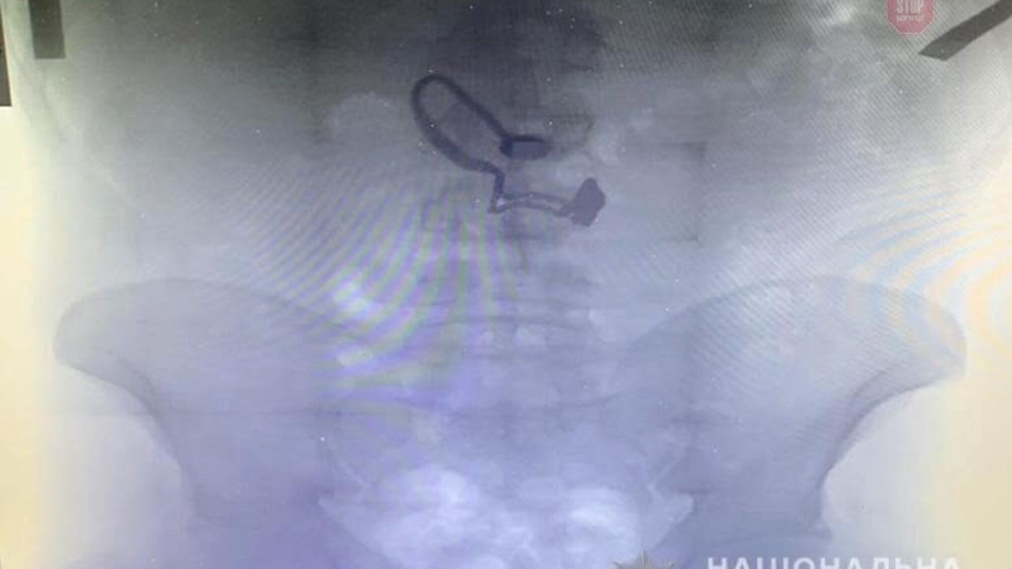 У Києві грабіжник проковтнув ланцюжок пенсіонерки (ФОТО)