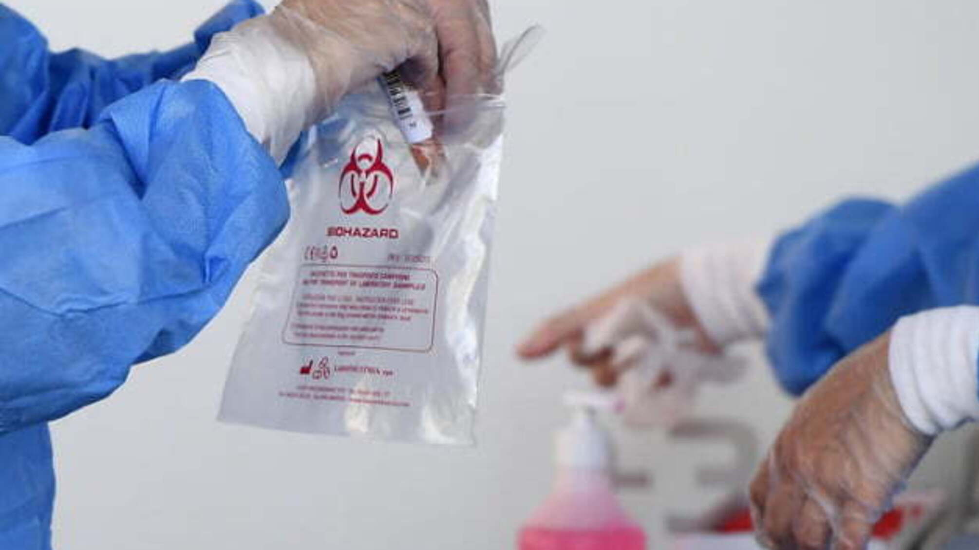 Проблеми з нирками підвищують ризик смерті хворих на COVID-19