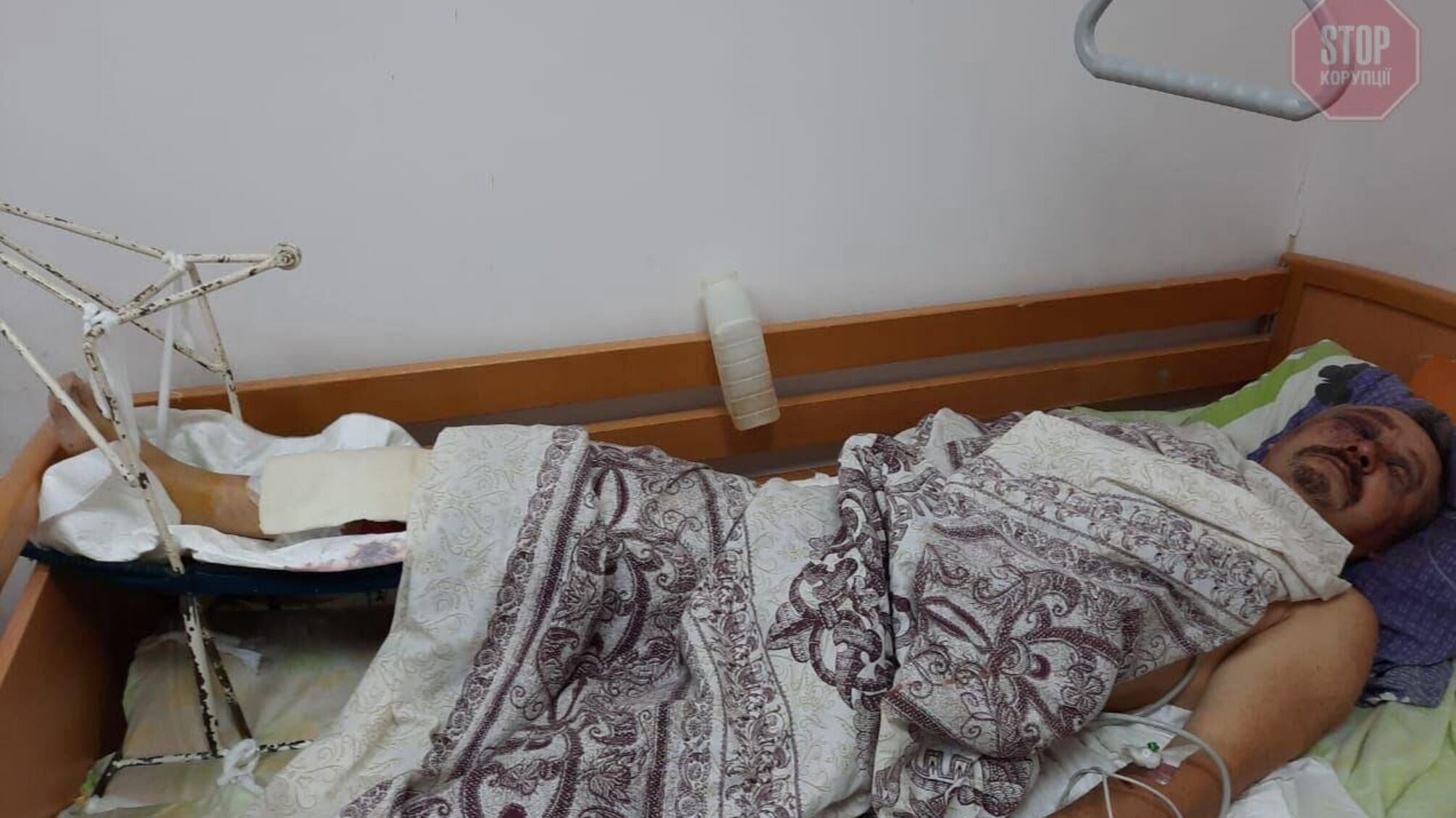 На Донеччині сильно побили колишнього депутата райради (фото)