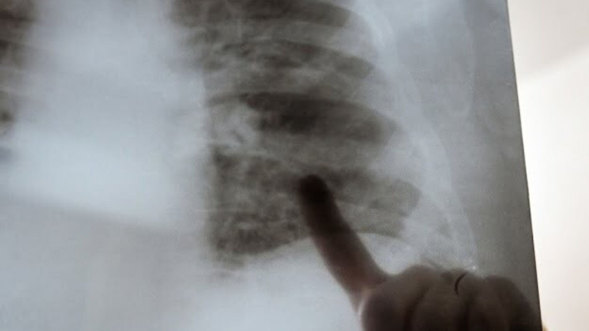 Кількість випадків коронавірусу в світі перевищила 60 мільйонів