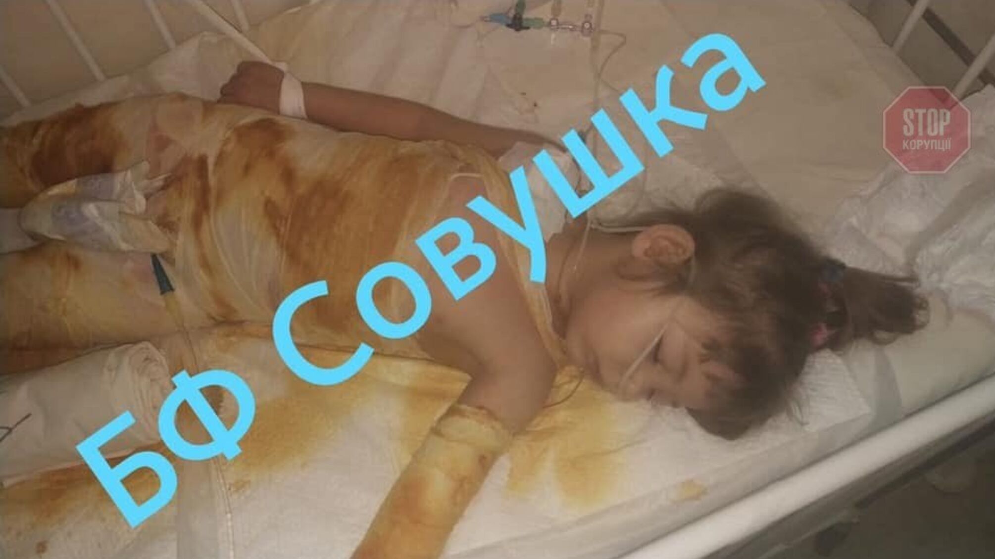 У Дніпрі дитина сіла у відро з окропом: дівчинку рятують медики