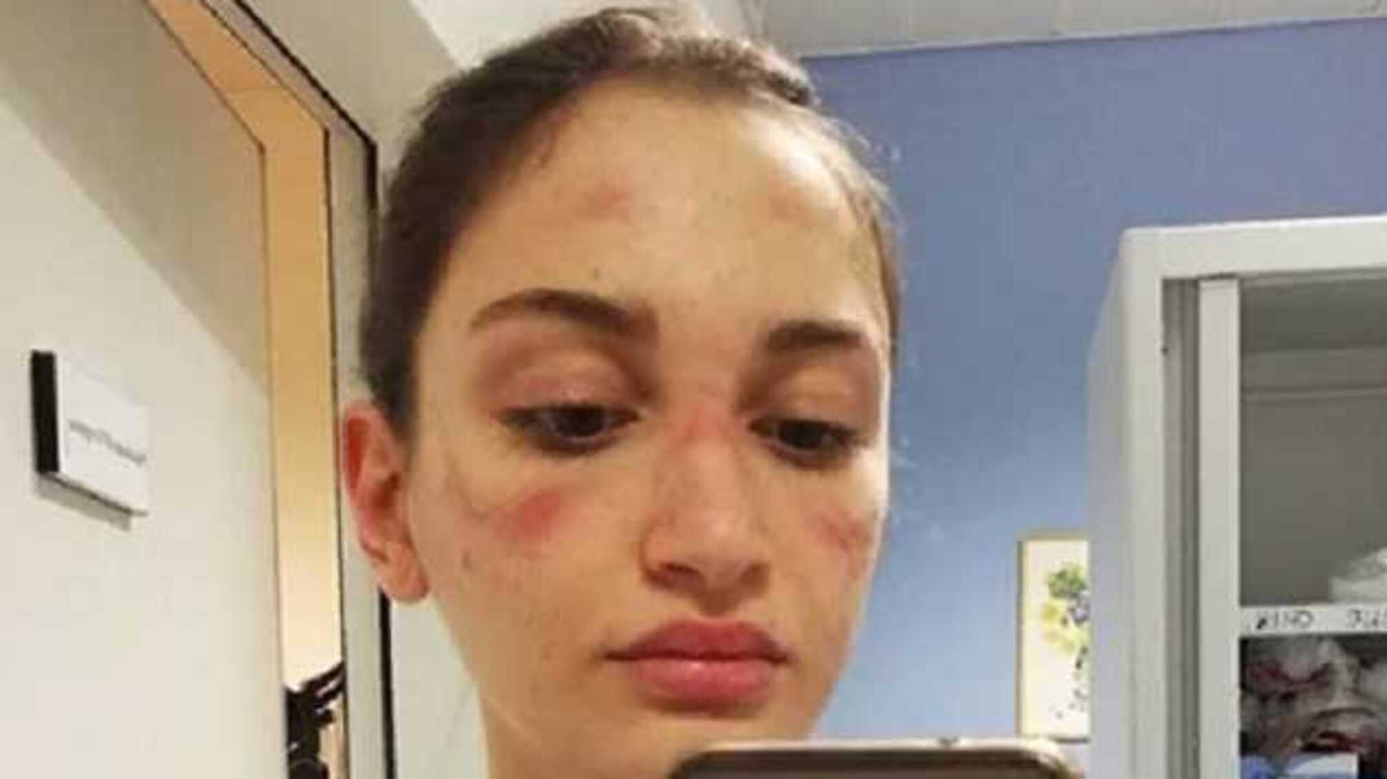 В Италии медсестра показала в сети лицо после многочасовой работы в маске и попросила ценить труд медиков