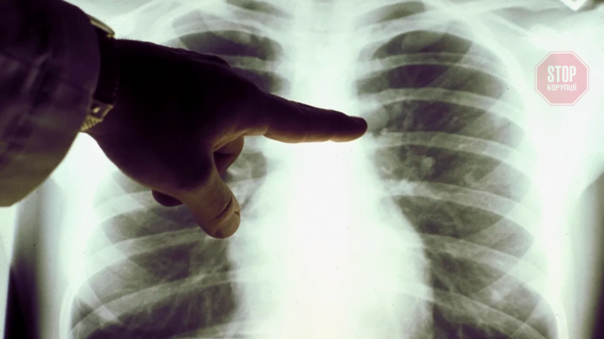 Двостороння пневмонія, 70% ураження легень: у Києві відмовили в шпиталізації хворого