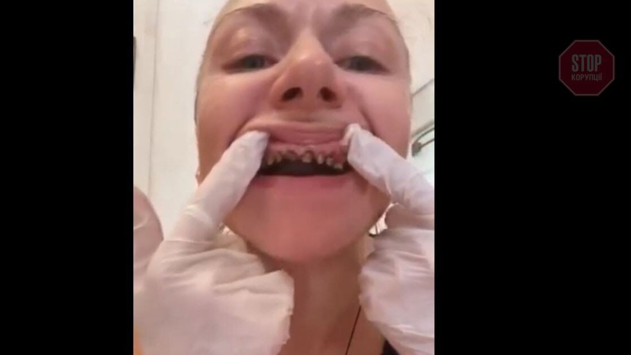 Киянка втратила зуби та 20 000$ на відбілюванні (відео)