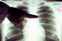 ''Було 100% ураження легень'': у Дніпрі медики врятували хворого на коронавірус