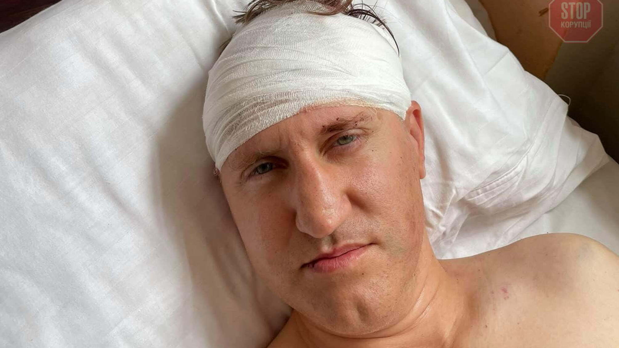 Кривава брудна справа: у Коростені побили депутата, який висвітлював проблему Грозинського сміттєзвалища