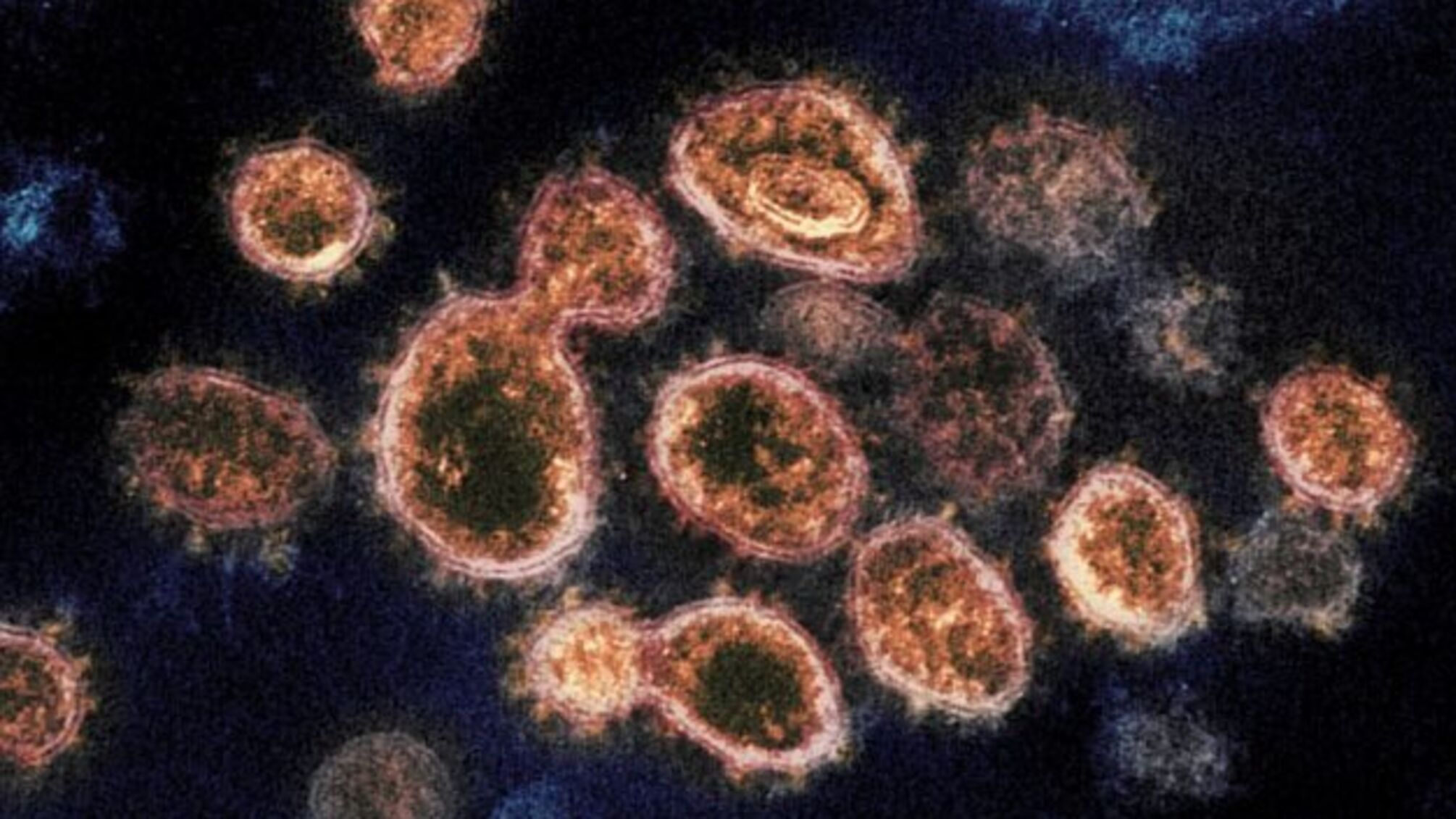 Гібридним штамом коронавірусу Дельтакрон уже захворіли 25 осіб