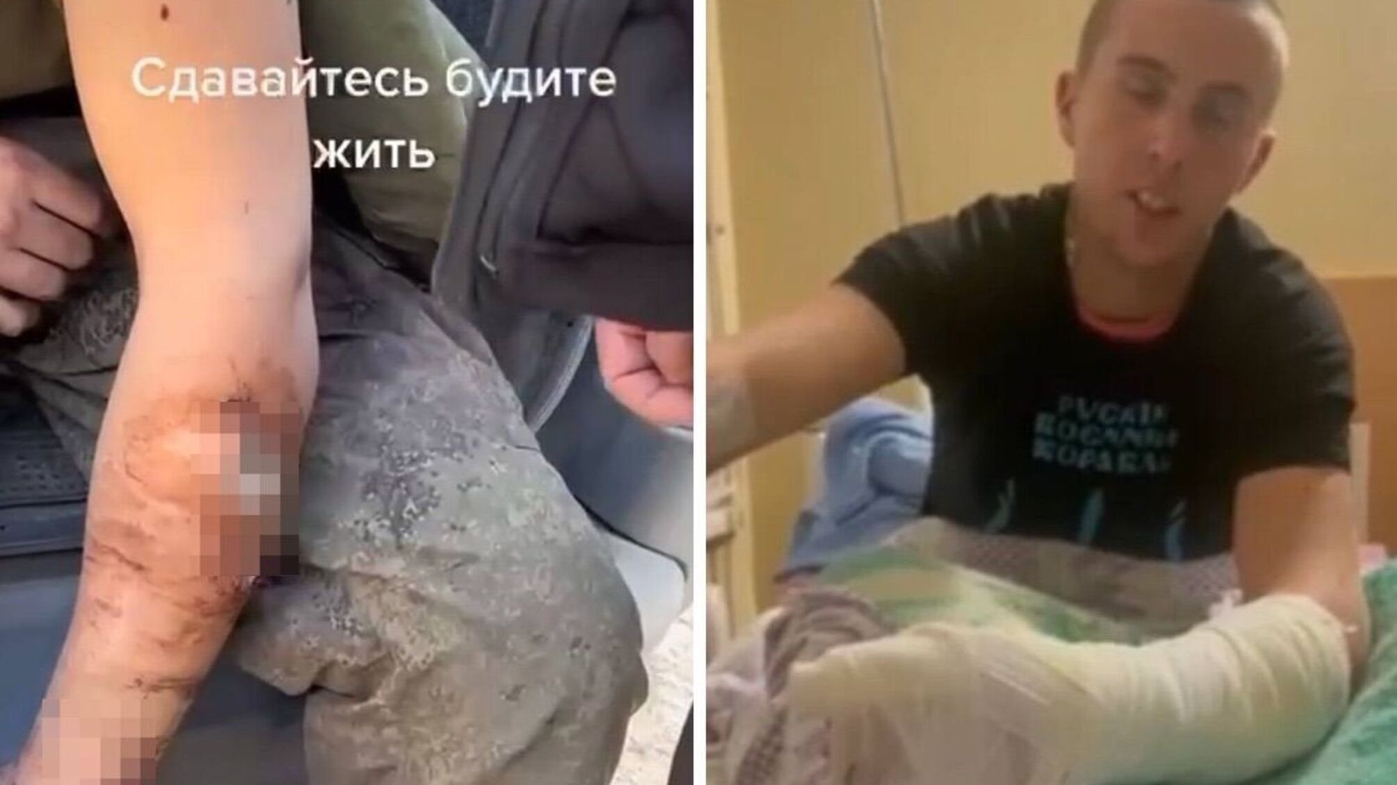 Парамедики ЗСУ врятували руку російському військовополоненому: гнив живцем (відео)