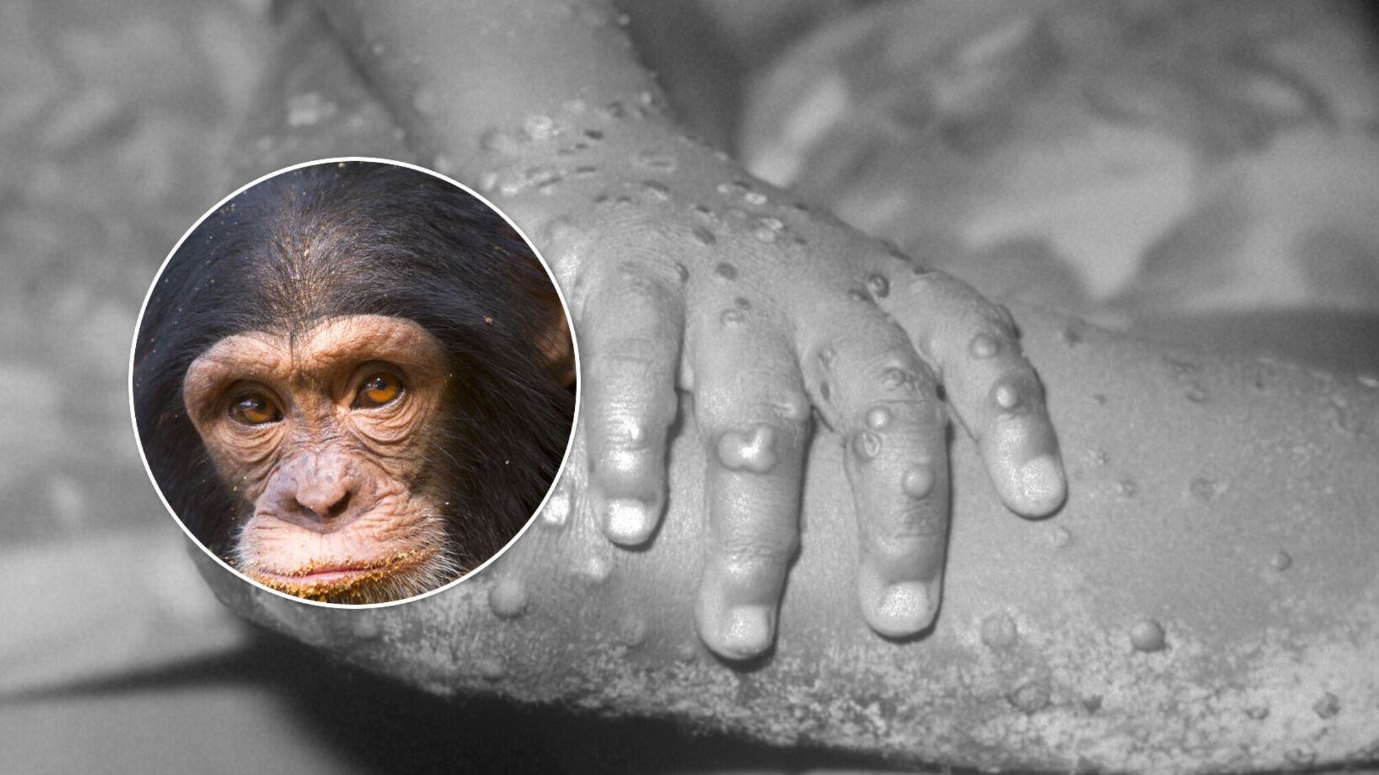 У Європі зафіксували перші випадки віспи мавп: що це за хвороба і чим вона небезпечна