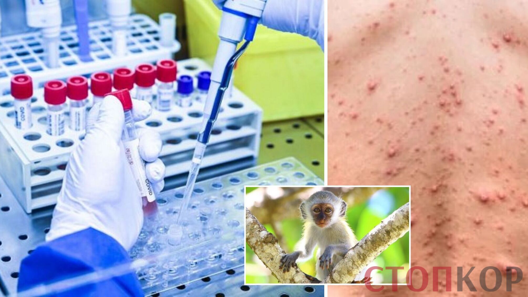 Обезьянья оспа: откуда происходит и какие симптомы