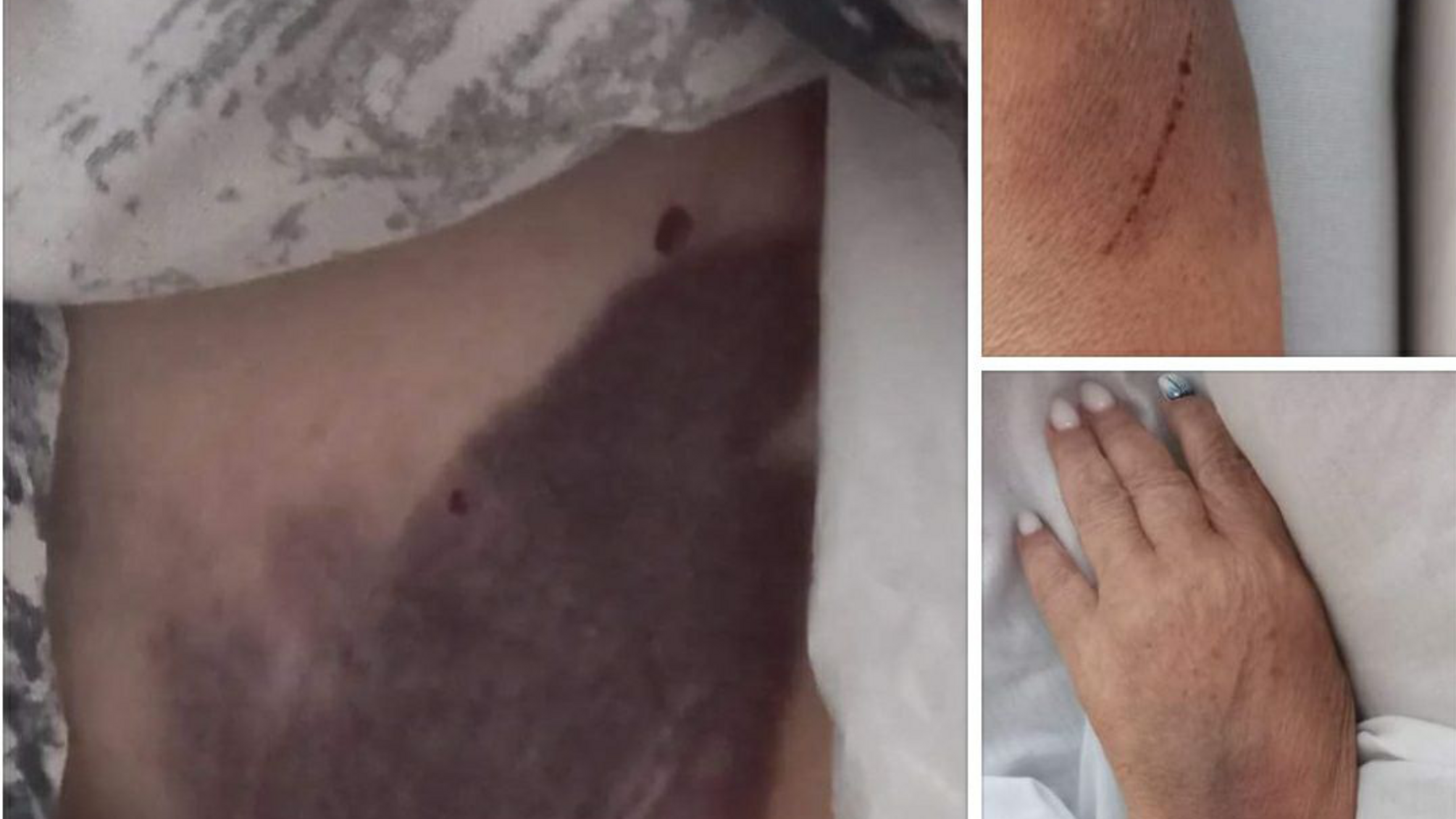 побиття побої поранення