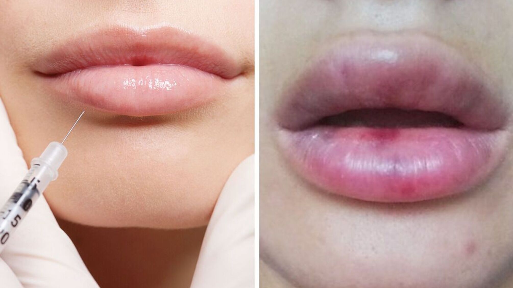 Как уменьшить губы