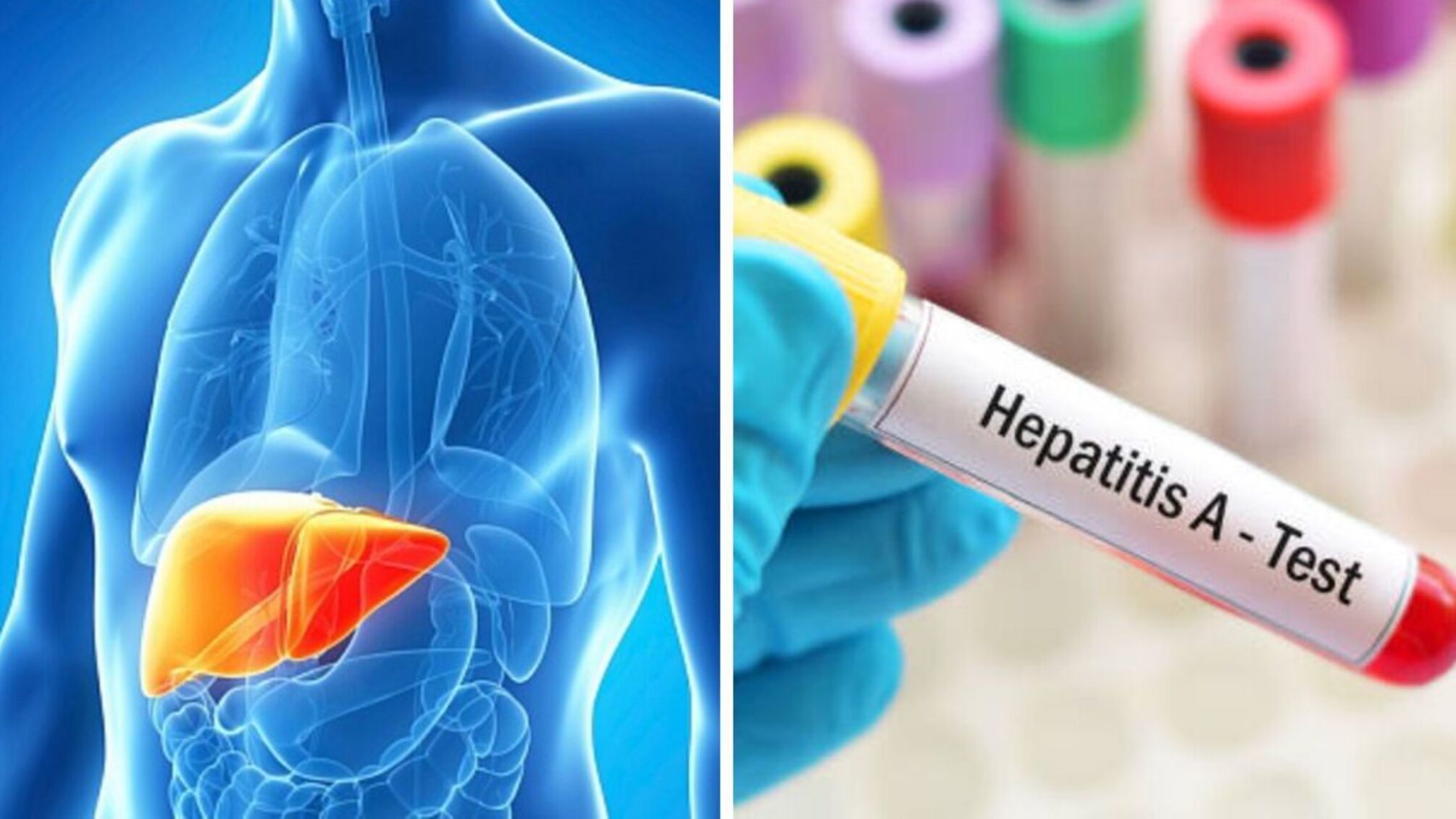 На Вінниччині зафіксували спалах вірусного гепатиту А