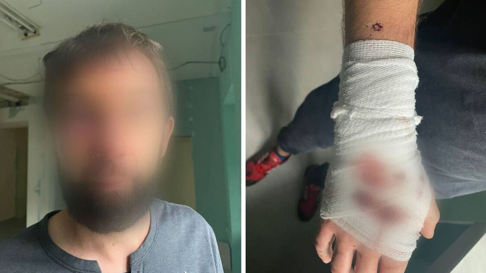 Сім куль у спину і переломи: у Києві невідомі зі зброєю напали на чоловіка  – деталі справи