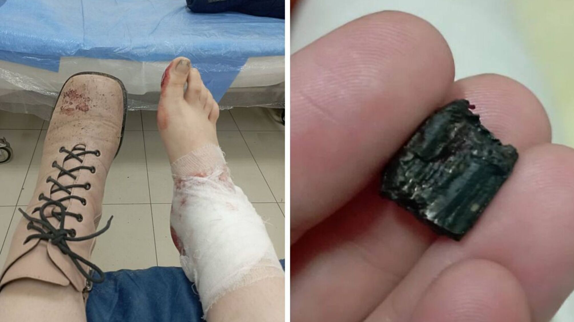 У дівчини перелом, вона була прооперована