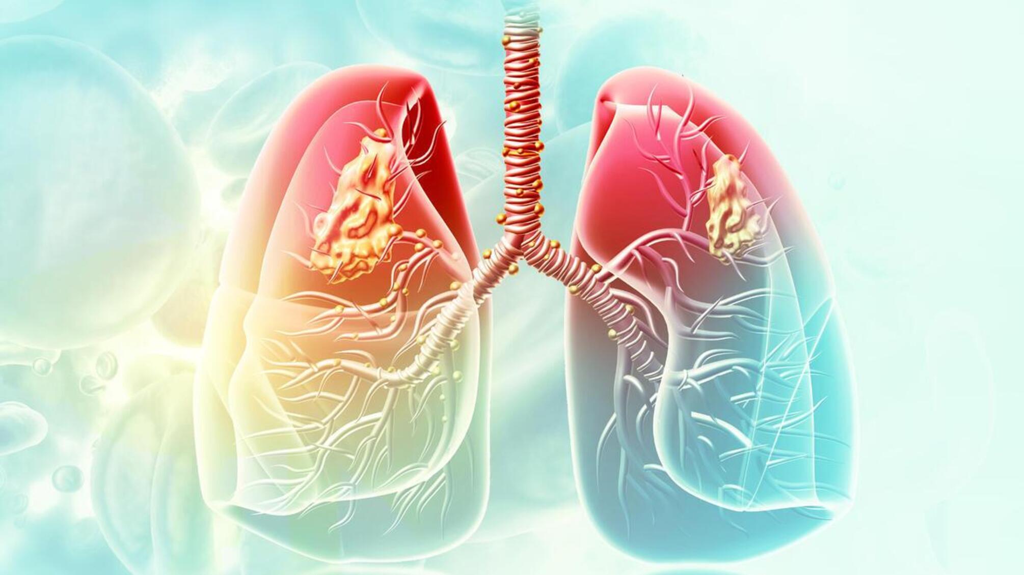 Всесвітній день боротьби з пневмонією 12 листопада: чому важливо знати про цю загрозу