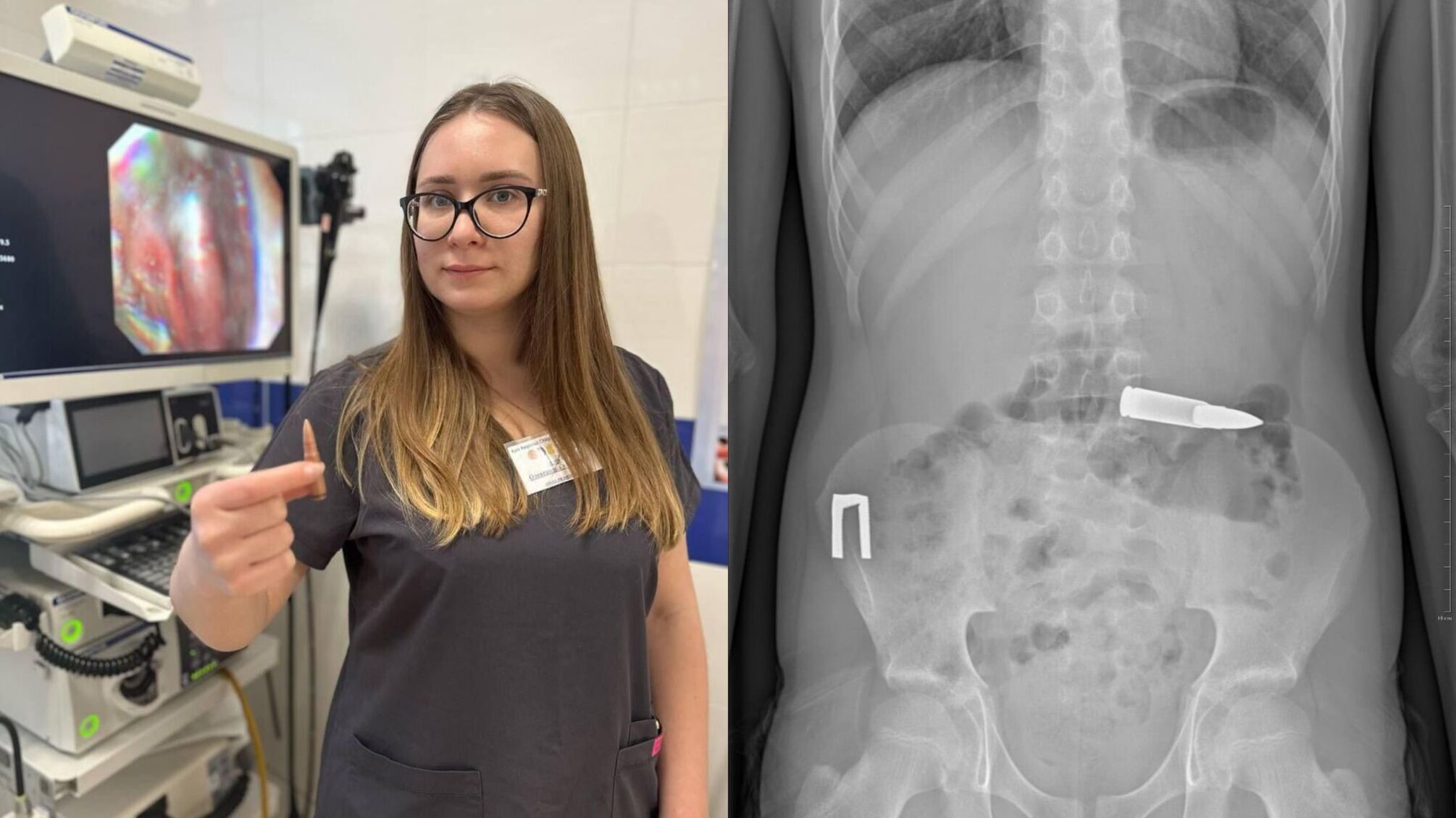 У Києві хлопчик проковтнув патрон