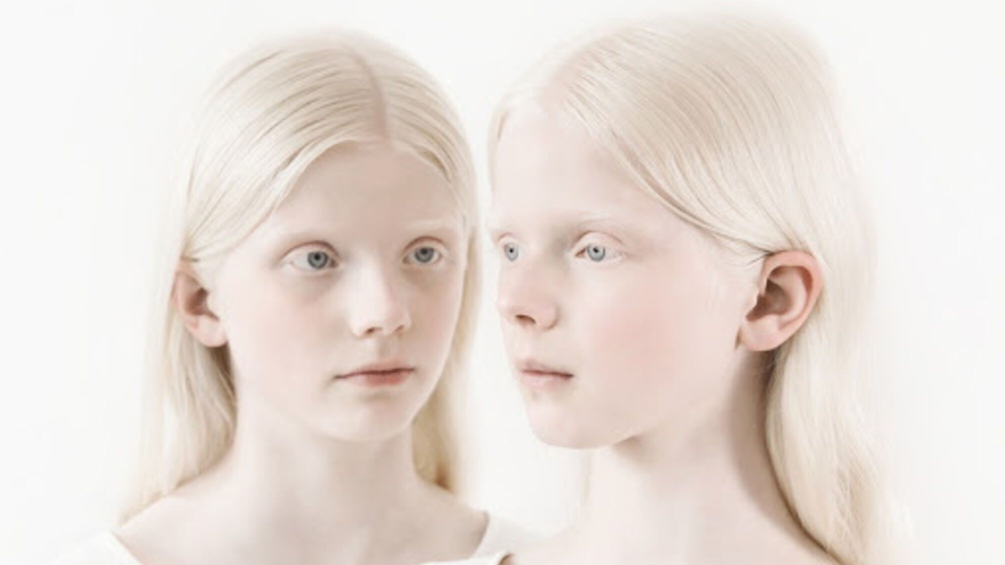 Международный день распространения информации об альбинизме: почему это важно?