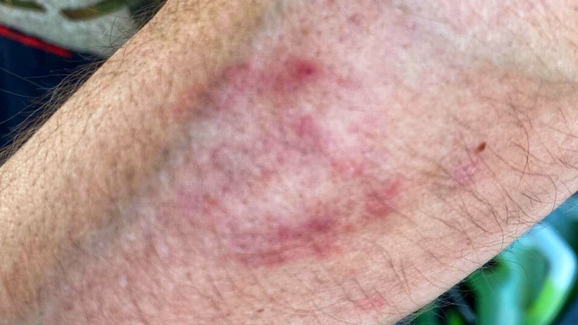 Полицейский в Херсоне пострадал от укуса 60-летней женщины во время проверки документов